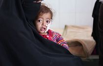 UNICEF: Iémen à beira da tragédia, meio milhão de crianças em subnutrição grave