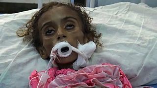 ديدان تفتك بطفلة في اليمن