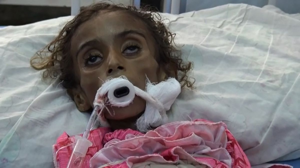 Seven-year-old Jamila is another victim of Yemen's civil war
