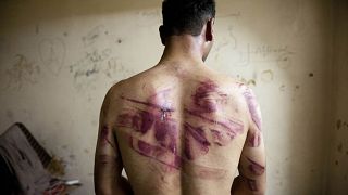 Image: A Syrian man shows marks of torture on his back, after he was releas