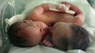 Ethiopian delivers conjoined twin boys in 'historic' birth