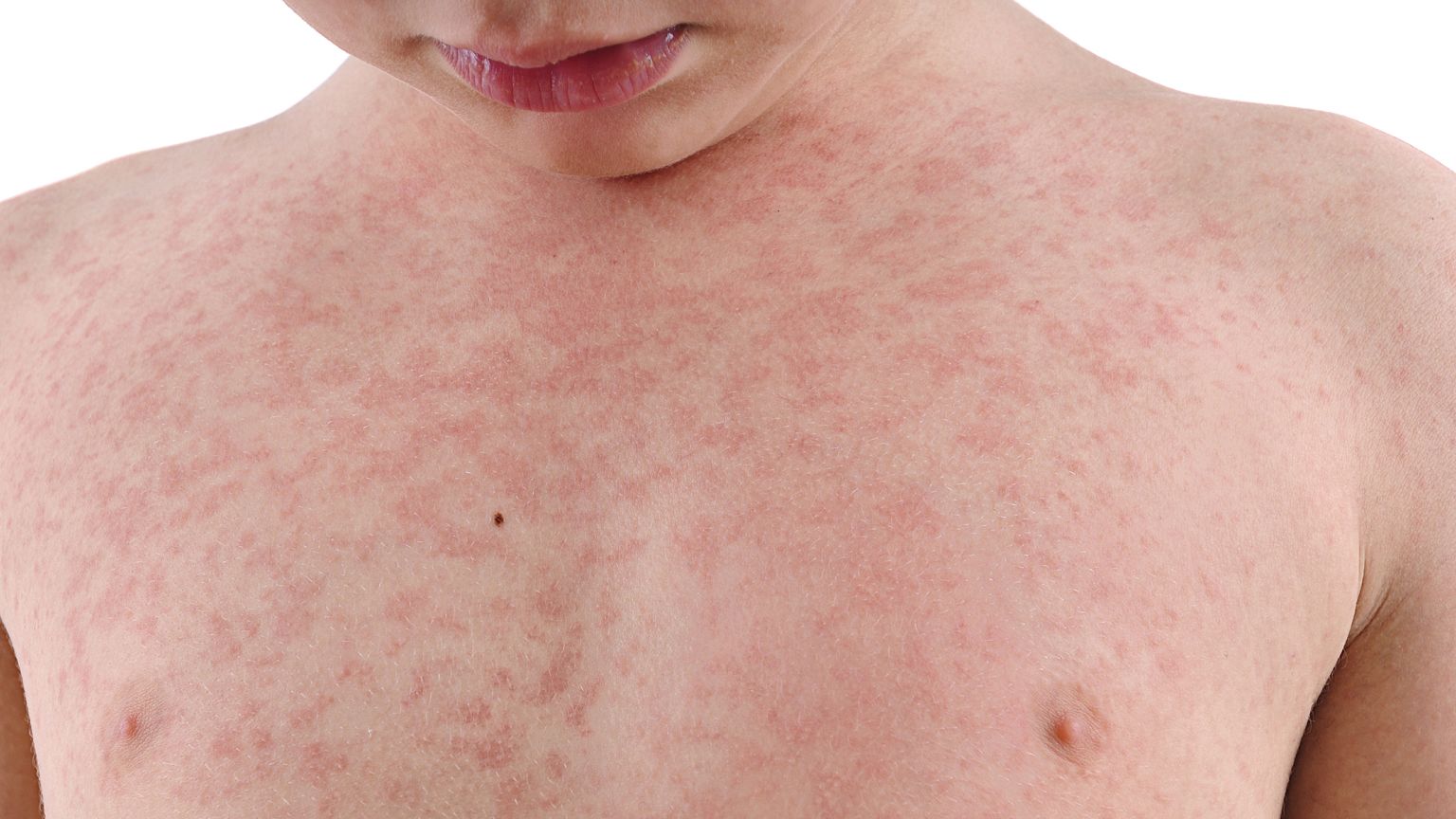 Nettle Rash Isolated