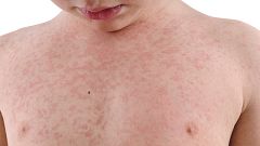 Nettle Rash Isolated
