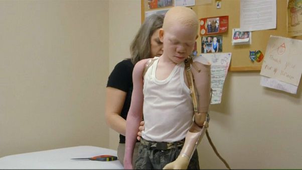 Sauver les albinos, victimes en Afrique Sauver les albinos, victimes en Afrique