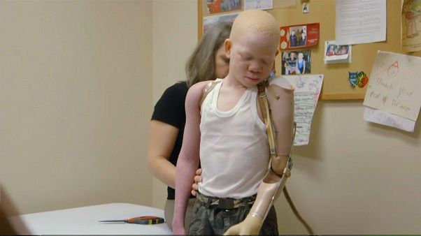 Une journée mondiale pour sauver les albinos, torturés en Afrique Une journée mondiale pour sauver les albinos, torturés en Afrique