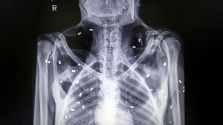 Image: An X-ray shows air rifle pellets inside the body of a female orangut