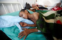 Crianças iemenitas malnutridas e face a uma epidemia de cólera mortífera