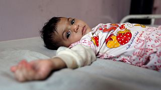 یمن؛ وبا در انتظار آنها که از سوء تغذیه جان بدر می برند
