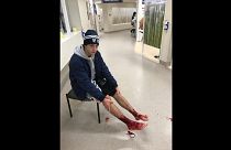 Australian teen hospitalised after vicious sea bugs attack