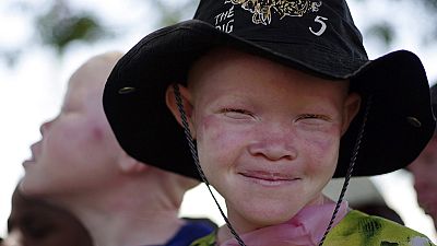 6 jailed 20 years for chopping off hand of albino boy in Tanzania