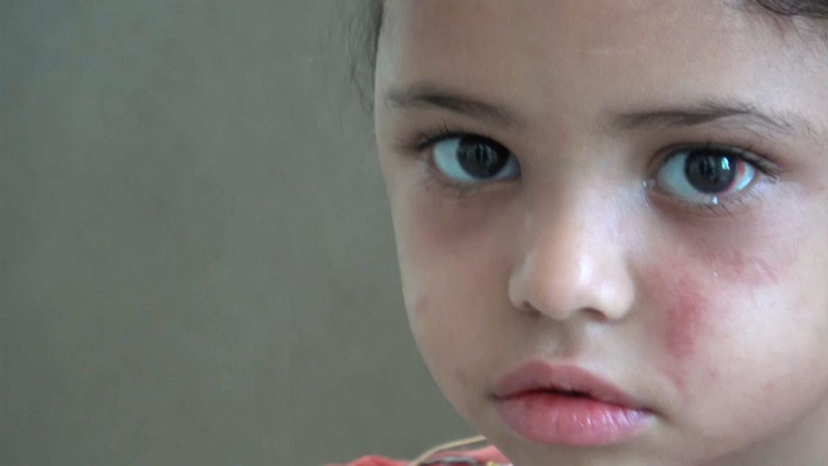 Sole strike survivor, 5, helps open world’s eyes to Yemen crisis