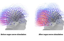 Man in vegetative state for 15 years 'shows signs of consciousness' after pioneering therapy