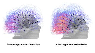 Man in vegetative state for 15 years 'shows signs of consciousness' after pioneering therapy