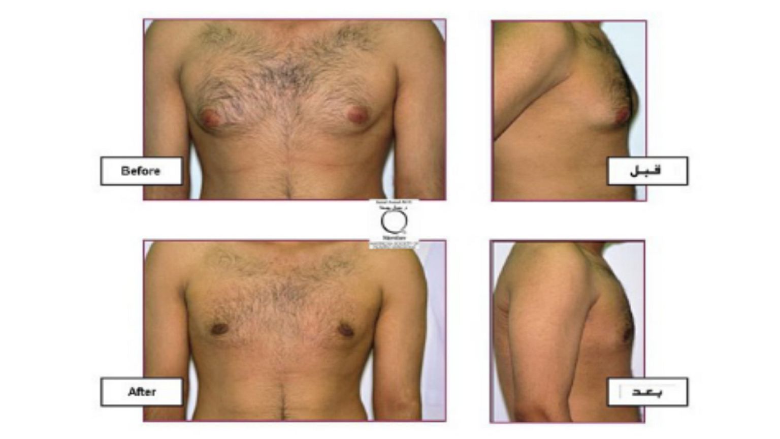ما هي عمليات التجميل الأكثر شيوعا لدى الرجال؟