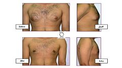 ما هي عمليات التجميل الأكثر شيوعا لدى الرجال؟