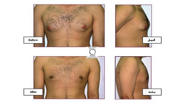 ما هي عمليات التجميل الأكثر شيوعا لدى الرجال؟ ما هي عمليات التجميل الأكثر شيوعا لدى الرجال؟
