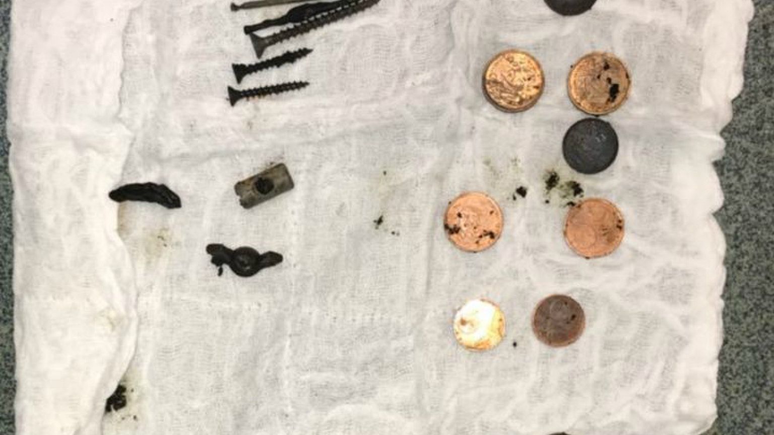 Hastanın midesinden 100'den fazla metal parça çıkarıldı