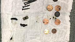 Hastanın midesinden 100'den fazla metal parça çıkarıldı