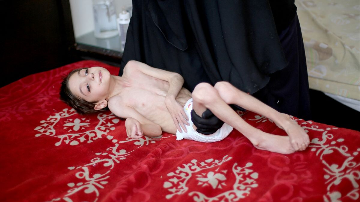 المجاعة تفتك بأطفال الغوطة الشرقية