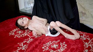 المجاعة تفتك بأطفال الغوطة الشرقية