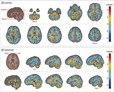 Maps of white matter and gray matter tissue volume were created for each participant using T1-weighted images and registering them to a template. For panel A, axial views of the brain, and panel B, sagittal views of the cerebellum and cerebrum, locations of chosen slices are shown by
red lines on the template brain (first image in each panel).