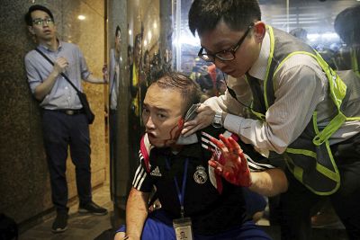 District councilor Andrew Chiu receives medical treatment in Hong Kong on Sunday after a knife-wielding man bit off part of his the ear.