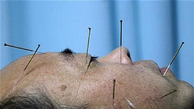 Acupuncture popular with Congolese patients