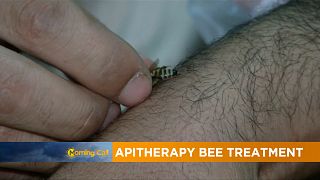 Apitherapy bee treatment for pain [The Morning Call]