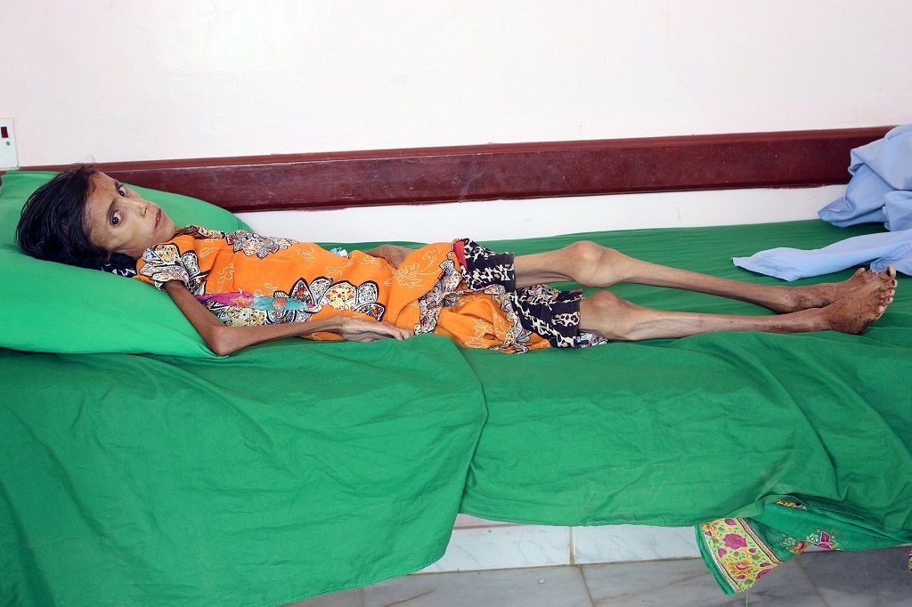 Starving Girl Shows Devastating Impact Of Yemeni War The Ghana Guardian News