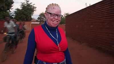 Au Malawi, les élections ravivent les craintes des albinos