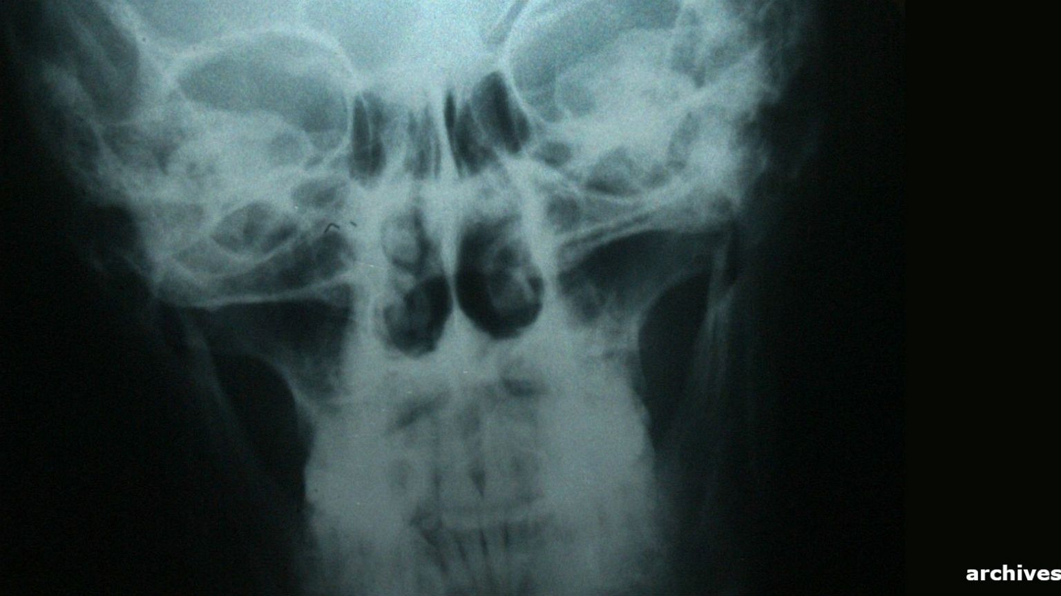 Première greffe de tête humaine réalisée... sur un cadavre 