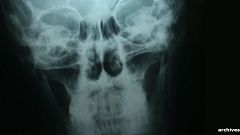 Première greffe de tête humaine réalisée... sur un cadavre 