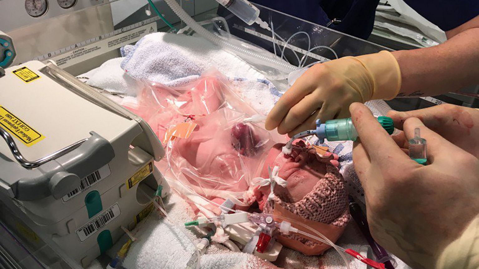 Κοριτσάκι γεννήθηκε με την καρδιά έξω από το σώμα του