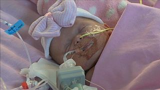 Primer bebé británico que sobrevive tras nacer con el corazón fuera