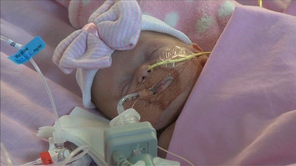 Primer bebé británico que sobrevive tras nacer con el corazón fuera Primer bebé británico que sobrevive tras nacer con el corazón fuera