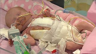 Baby born with heart outside body survives against the odds