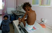 سوءتغذیه کودکان یمن