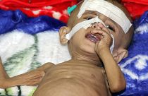 طفل يمني يعاني المرض في ظل استمرار الحصار