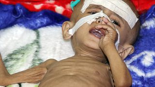 طفل يمني يعاني المرض في ظل استمرار الحصار 