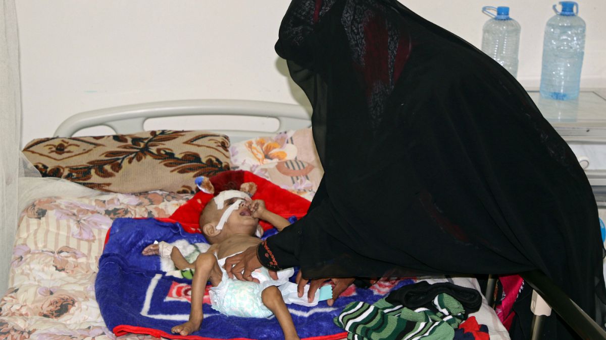 کودکی یمنی که از سوءتغذیه رنج می برد 
