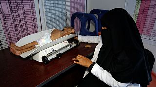 a malnutrition treatment center in the Red Sea port city of Hodeida