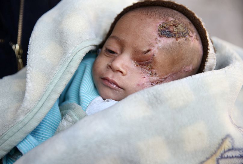 Durch Bombe verletzter Säugling (29.11.17)
