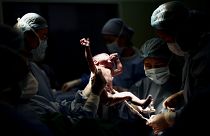 Un médecin tient un nouveau-né pendant qu'un autre coupe le cordon