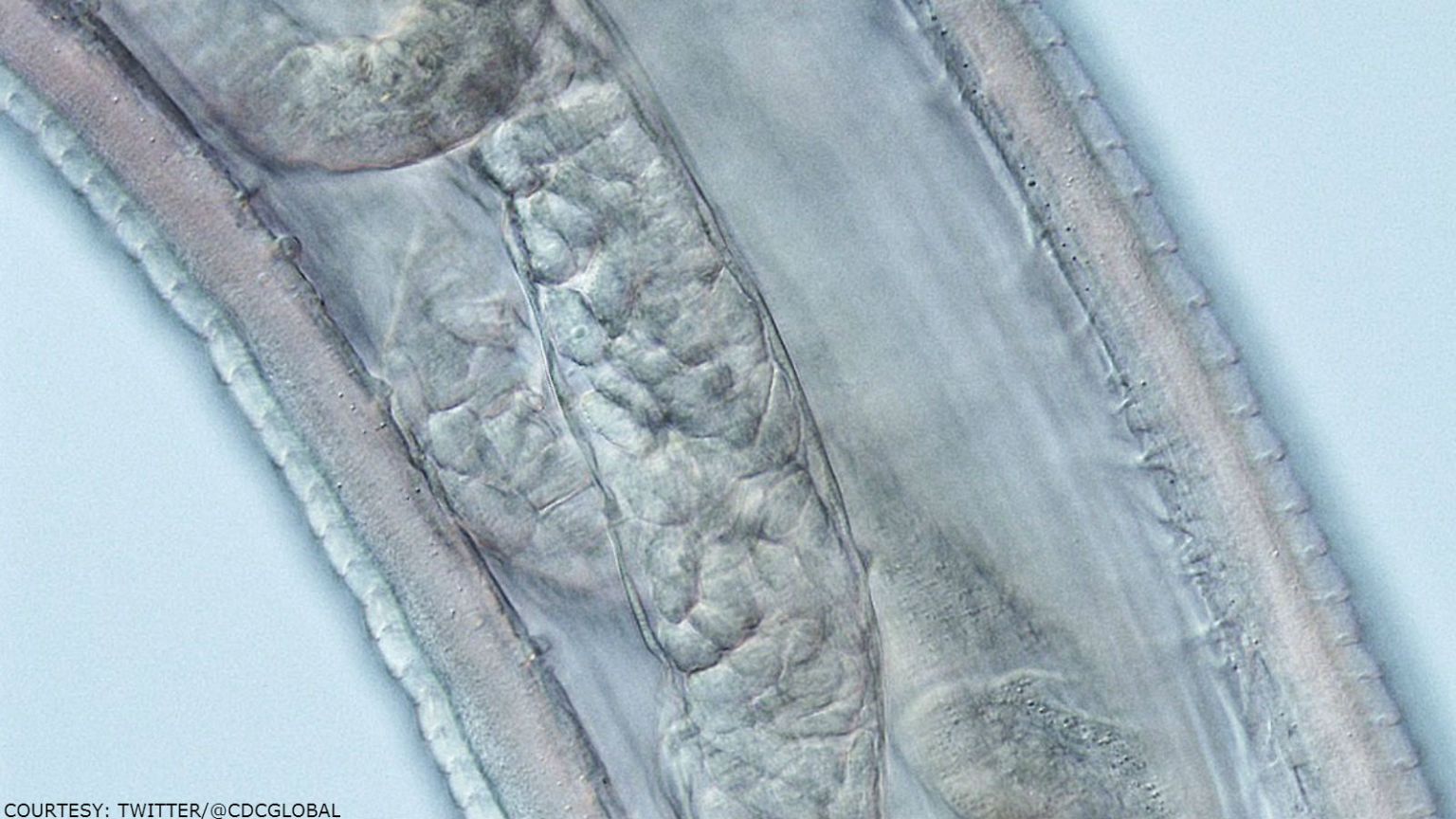 US woman first-ever human infected with parasitic cattle eye worms
