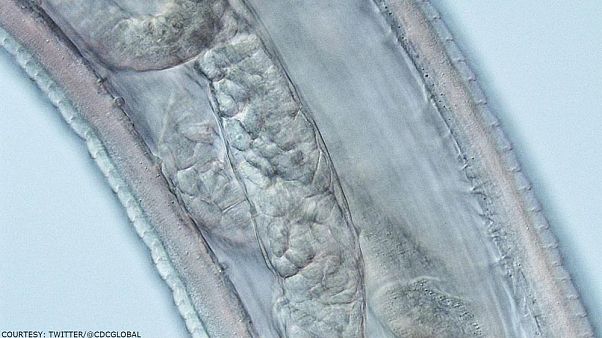 USA: Frau hatte 14 Rinderwürmer im Auge