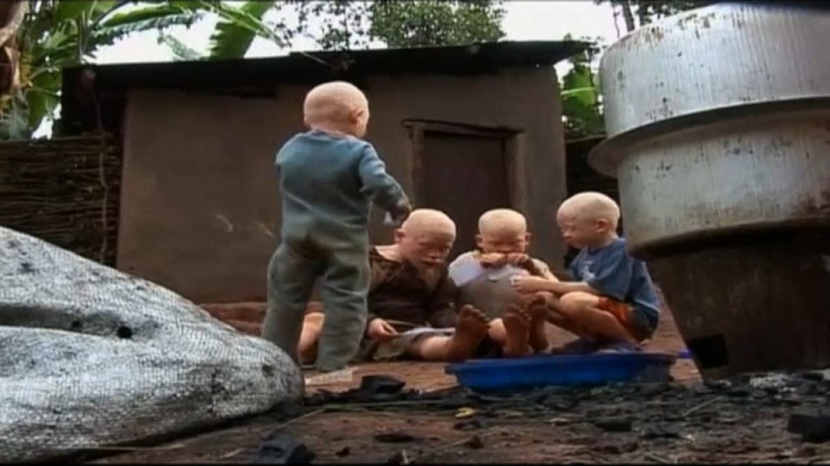 Albinos vítimas de perseguição em Moçambique