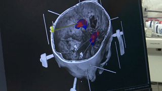 عملية جراحية للدماغ قام بها روبوت في فنلندا