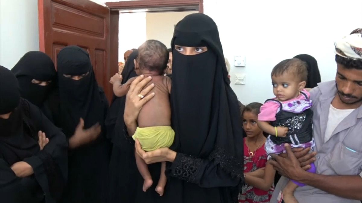 شاهد: سوء التغذية يفتك بأطفال اليمن