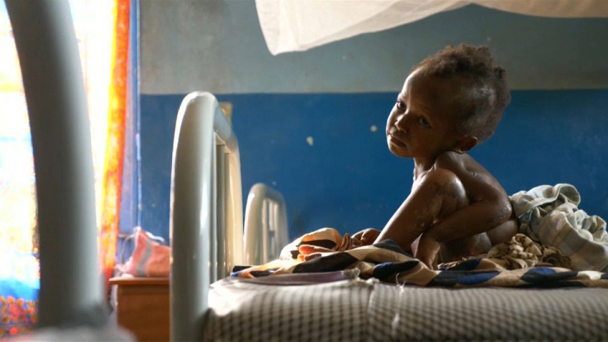 Kasaï : des enfants malnutris par centaines de milliers