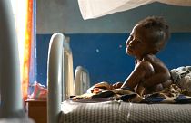 400.000 Kindern im Kongo droht der Hungertod